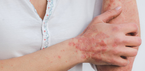 In-der-Haut-wohlfühlen-1_psoriasis-g263428abf_1280